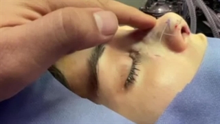 عمل زیبایی بینی خانم جوان | کلینیک جوان