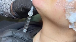 تزریق فیلر چانه و لب  | کلینیک زیبایی رژوه