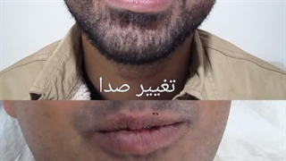 جراحی تغییر صدا توسط معروفترین جراح فوق تخصص حنجره ایران، دکتر زهرا سرافراز