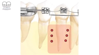 ارتودنسی سریع 3