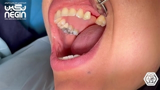 بستن هیلینگ دندان - دکتر نگین اثنی عشری برداشتن خال گوشتی