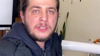 ایمپلنت لمینت و روکش برای کسی که از دندانپزشکی ترس داشت