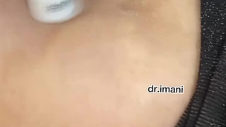 میکرودرم ابریژن در مشهد برداشتن زگیل