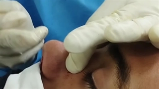 بلافاصله پس از جراحی بینی (دکتر ندا سخی)