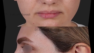 عمل زیبایی بینی