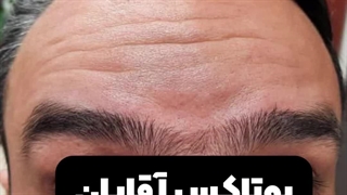 تزریق بوتاکس آقایان در کرج