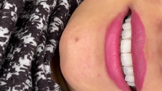 قبل و بعد لمینت دندان