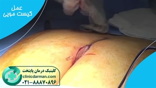 عمل کیست مویی باز بهتر است یا بسته؟