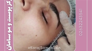 پلکسر با پلاسماجت در کرج ترمیم سوختگی