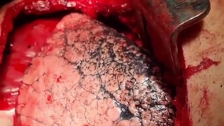 ریه فرد سیگاری تو 30 سال سیگار کشیدن