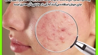 هزینه لیزر جای جوش لیفت پیشانی