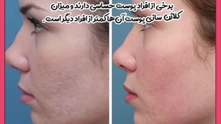 علت فرورفتگی ناگهانی پوست صورت جراحی گوش