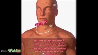 پکیج درمان سیفلیس و سوزاک