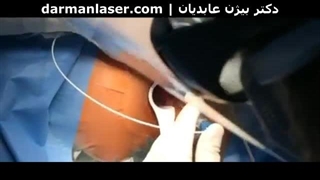 درمان بواسیر با لیزر بدون هیچ خونریزی و درد در درمان تهران ترمیم دندان