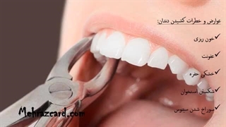 کشیدن دندان