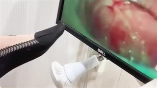 کولپوسکوپی دهانه رحم در بیماری که ترشحات عفونی زیادی داشت!!