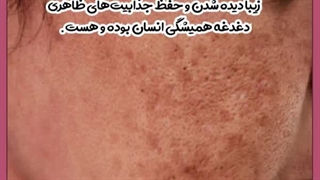درمان لک صورت تزریق ژل
