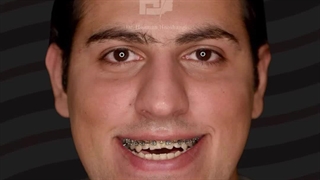 قبل و بعد از جراحی فک