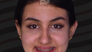 جراحی همزمان دو فک و چانه