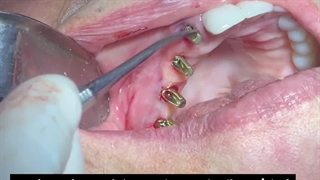 ایمپلنت یک روزه تمام فک