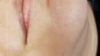 تزریق ژل در کرج