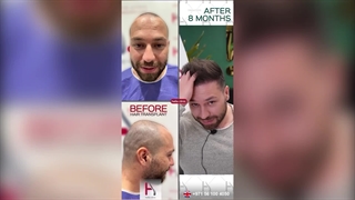 Micrograft Hair Transplantation - A Permanent Solution for Hair Loss