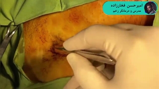 همه چیز درباره سینوس پیلونیدال - امیرحسن فخارزاده مدرس و درمانگر زخم