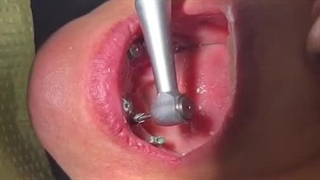 فیلم زنده تحویل روکش ایمپلنت