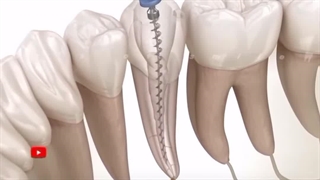 مراحل عصب کشی دندان (دندانپزشکی شبانه روزی دریا )