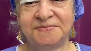 بلفاروپلاستی در مشهد همراه با تجربیات بیمار پس از عمل