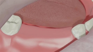 ایمپلنت آمریکایی