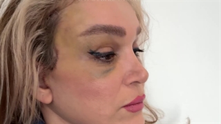 جراحی لیفت صورت به روش دیپ پلین - لیفت صورت در تهران