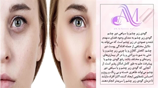 گودی زیر چشمت رو حتما اینجوری از بین ببر