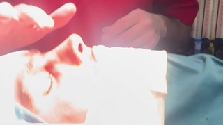 قبل و بلافاصله پس از عمل زیبایی بینی همراه با ورم زیاد