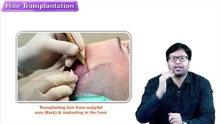 کاشت مو دائمی