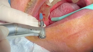 فیلم رضایت از ایمپلنت یک روزه (ایمپلنت فوری)