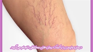 درمان واریس با لیزر در قم