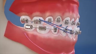 Class III Elastics - Lateral View (HD)