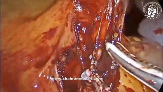 کولکتومی سمت راست لاپاروسکوپیک (برای سرطان زاویه کبدی روده بزرگ)