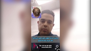 زراعة الشعر - بعد 8 أشهر بشعر جدید