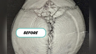 کلاه اصلاحی فرم سر نوزاد | کلینیک پژم