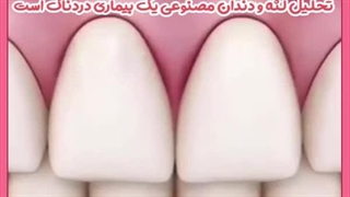 لمینت دندان با بیمه عصب‌کشی