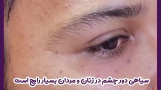 دلایل سیاهی دور چشم