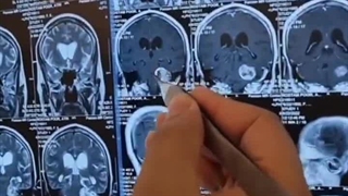 جراحی تومور قاعده جمجمه