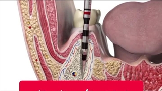 دندان دائمی تکه تکه