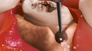 استخراج از طریق جراحی و پیوند مناسب