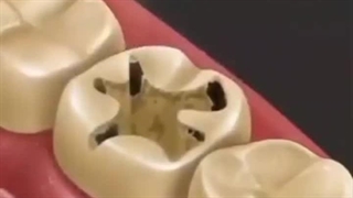 نحوه پر کردن دندان