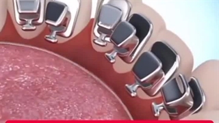 ارتودنسی داخلی دهان