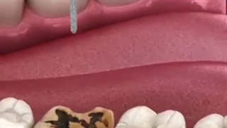 فرآیند حذف پوسیدگی