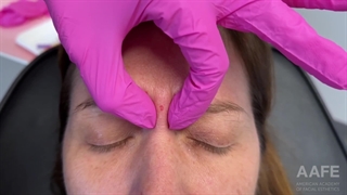 ویدئویی کوتاه از چگونگی انجام بوتاکس